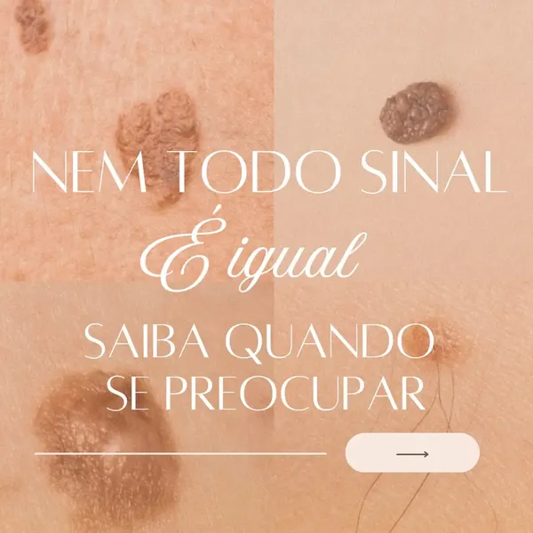 Post no Instagram da Dra. Ana Luiza sobre avaliação de nevos